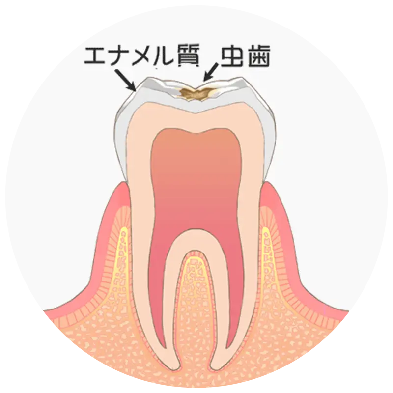 歯の表層（エナメル質）の虫歯