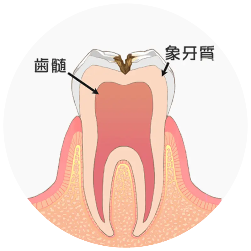 歯の中（象牙質）の虫歯