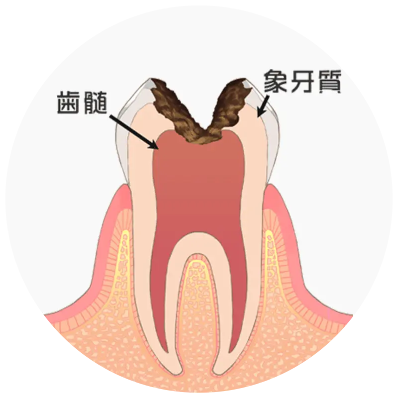 神経まで達した虫歯