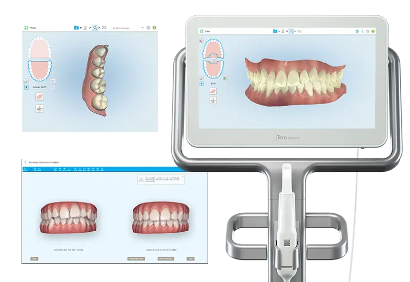 口腔内スキャナ「iTero」
