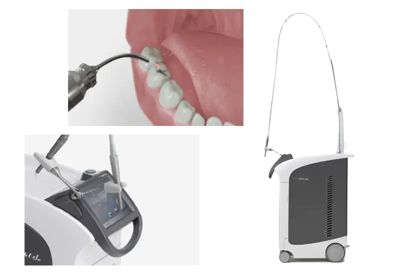 歯科用レーザー