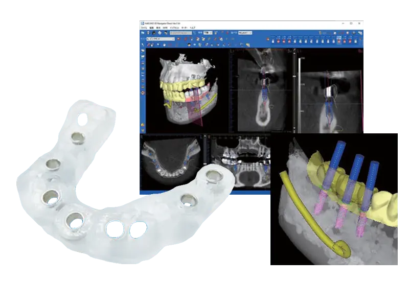 サージカルガイド