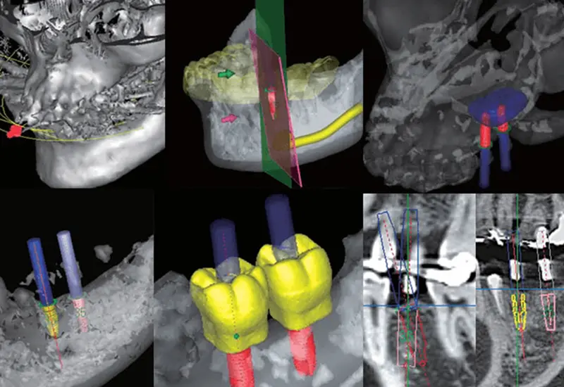 精度の高い治療計画