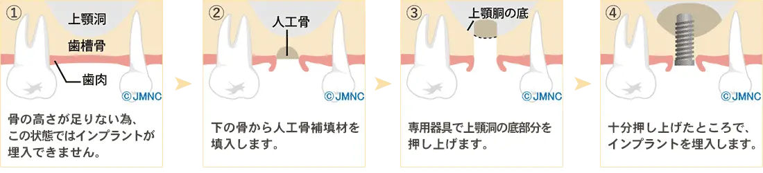 サイナスリフト法