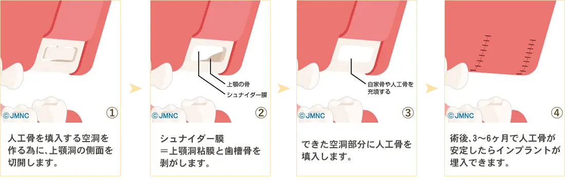 ソケットリフト法