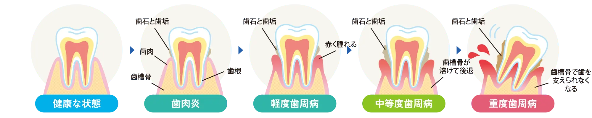 歯周病の進行